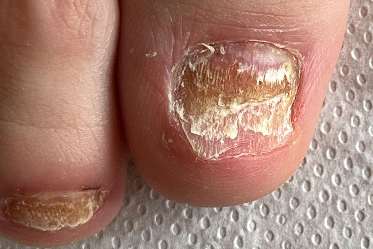 Ein Fuß eines Diabetikers mit Nagelpilz