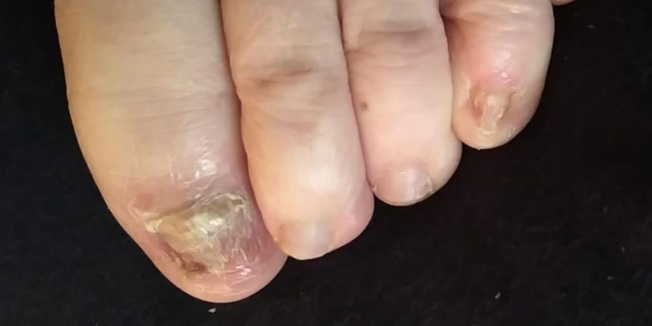 Fuß mit Nagelpilz am großen Zeh