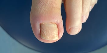 Lichen Planus und Nagelprobleme: Eine störende, chronische Erkrankung