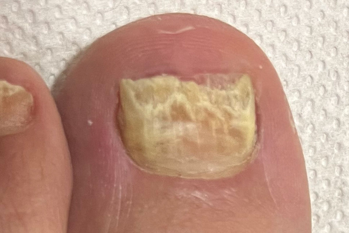 Patient mit Fußschmerzen oder Nagelschmerzen 