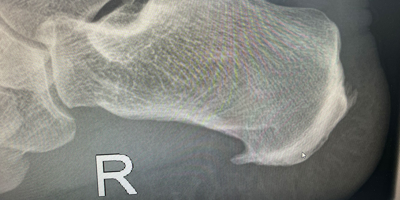 Plantarfasziitis: Schmerzen im Fuß effektiv behandeln