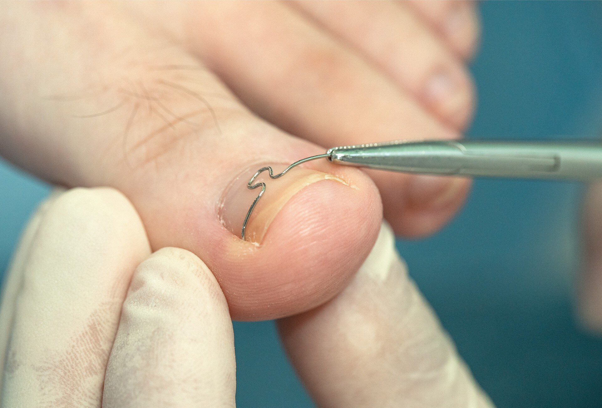 Fuß an dem eine Nagelspange angebracht wird.